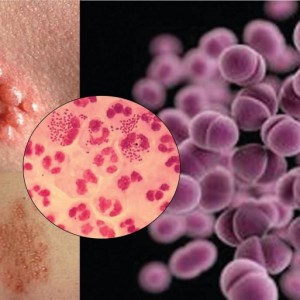 Высыпания в паху у мужчин Причины высыпний в паху у мужчин