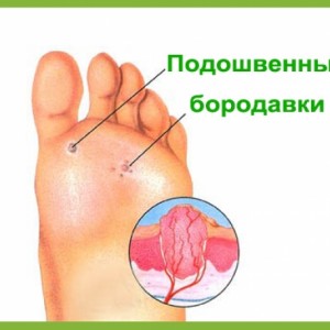 Подошвенные бородавки Бородавка на стопе методы избавления