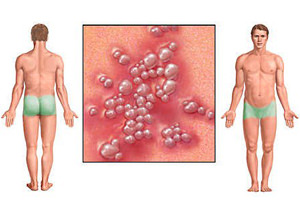 Генитальное заболевание у мужчин Симптомы полового герпеса у женщин