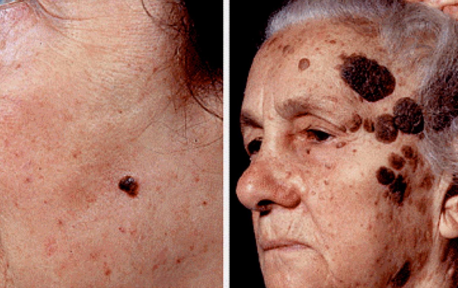 Кератома лица тяжелый случай Новообразование Кератома: признаки появления и лечение