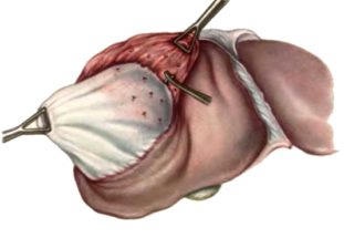 Удаление эхинококковой кисты на печени