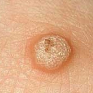 Разновидности бородавок Как вывести бородавки в домашних условиях