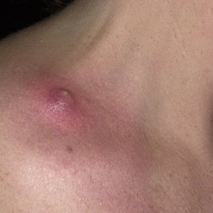 Чирии причины возникновения Чирьи причины возникновения и лечение