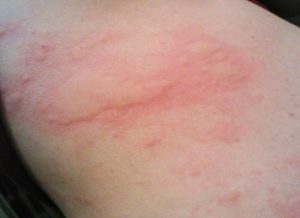 Крапивница