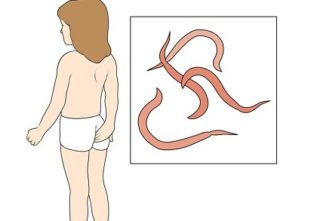 Симптомы и лечение энтеробиоза у детей