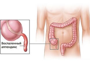 Аппендицит