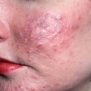 Заражение кожи демодексом Пупырышки, бугорки и прыщи на теле