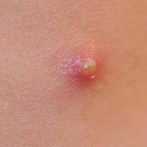 Чирей причины появления Чирьи причины возникновения и лечение