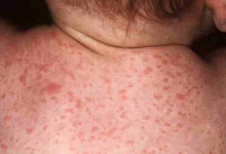 Краснуха у детей симптомы и лечение фото Причины появления краснухи и симптомы заражения у детей