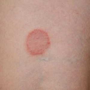 Средства при лишае Системные и наружные средства для борьбы с человеческими лишаями