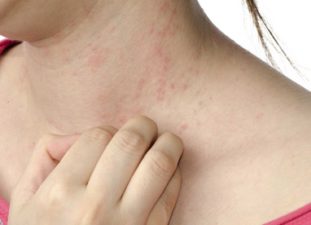 Сыпь при глистах