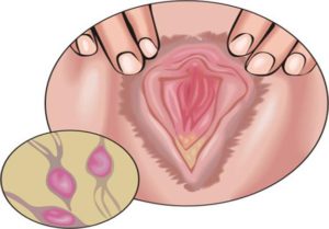 Влагалищные бели