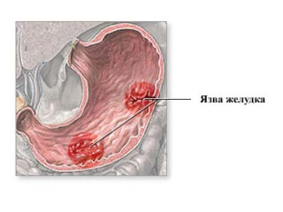 Лечебные свойства полыни горькой в борьбе с паразитами