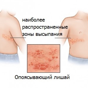Пузырьковый лишай фото Лишай простой пузырьковый: симптомы и лечение
