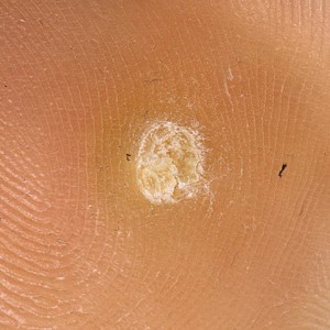 Симптомы пяточной бородавки Пяточная бородавка: причины появления и способы лечения