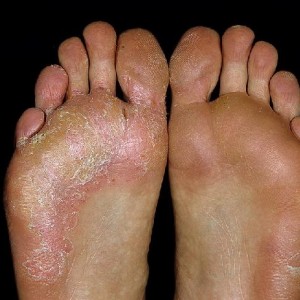 Тяжелая форма грибка стопы Мази от грибка стопы: список наиболее эффективных