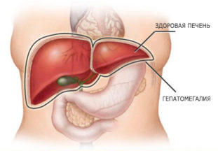 Гепатомегалия
