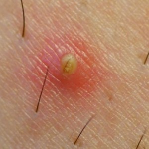 Пупырышки под мышками Пупырышки, бугорки и прыщи на теле