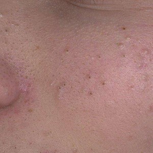 Причины возникновения комедонов на лице Что нужно знать о комедонах на лице?