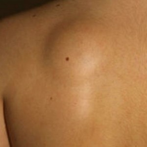 Липома на спине Появление жировика: причины, осложнения, фото воспаления