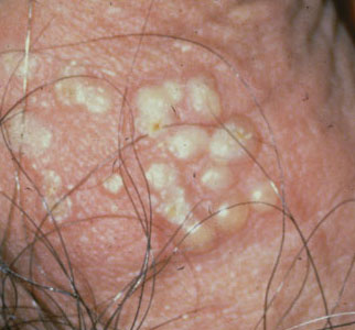 Острая форма генитального герпеса у мужчин и женщин Симптомы полового герпеса у женщин