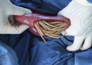 Что такое аскаридоз симптомы и лечение заболевания