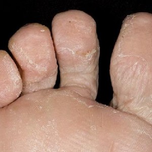 Симптомы грибка стопы Мази от грибка стопы: список наиболее эффективных