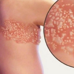 Пузырьковый лишай Лишай простой пузырьковый: симптомы и лечение