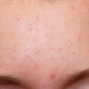 Мелкие прыщики на лбу как сыпь Мелкие прыщики на лбу как сыпь причины появления