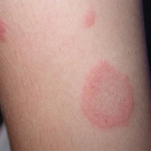 Лишай на коже Как выглядит лишай у человека, его симптомы и лечение