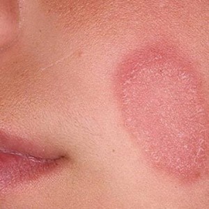 Мазь от розового лишая у детей Розовый лишай у человека: какие мази эффективно справятся