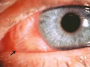 Описторхоз