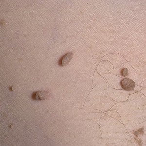 Проявление папилломавируса Папилломавирус человека: симптомы, лечение, профилактика