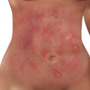 Лекарства при лишае Системные и наружные средства для борьбы с человеческими лишаями