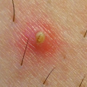 Фурункул на женских половых органах Что нужно знать при появлении фурункула на интимном месте?