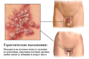 Генитальный вид заболевания герпес Симптомы полового герпеса у женщин