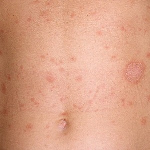 Мазь от розового лишая на теле Розовый лишай у человека: какие мази эффективно справятся