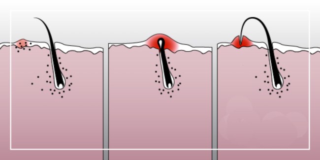 Почему врастают волосы: как с этим бороться