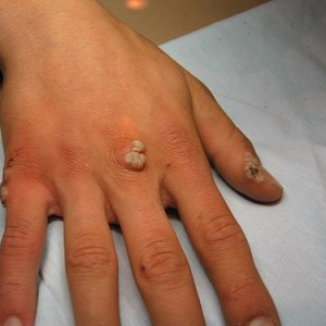 Как выводить бородавки в домашних условиях Как вывести бородавки в домашних условиях