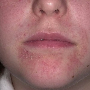 Зуд покраснение шелушение кожи О чём говорят красные шелушащиеся пятна на лице?