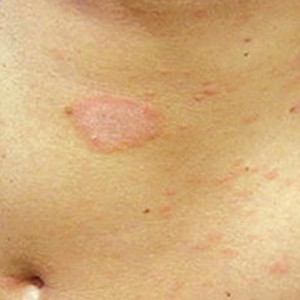 Таблетки для лечения лишая Системные и наружные средства для борьбы с человеческими лишаями