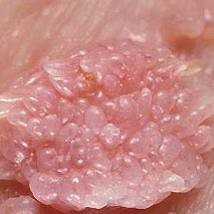 Лечение папилломовируса у женщин Препараты для лечения ВПЧ у женщин