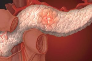 Панкреатит